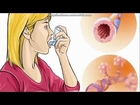 How To Treat Asthma Without An Inhaler | Asthma Natural Treatment In Children And Adults
