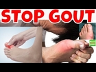 Prevent GOUT Natural Ways to Prevent Gout with Home Remedies