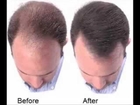 How to Stop Hair Loss Fast | Exact Methode to Stop Hair Loss and Grow It Fast